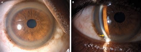 Kayser–Fleischer Rings in Wilson’s Disease | NEJM