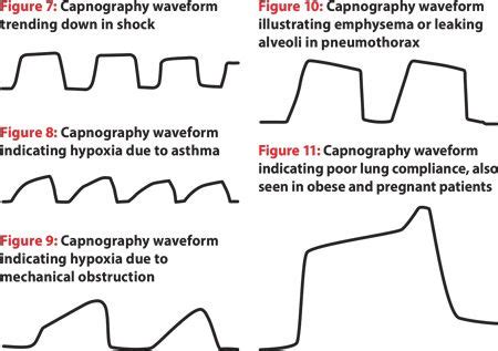 How to Read and Interpret End-Tidal Capnography Waveforms - Journal of ...