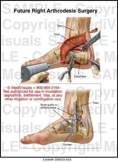 Future Right Arthrodesis Surgery Medical Exhibit Medivisuals