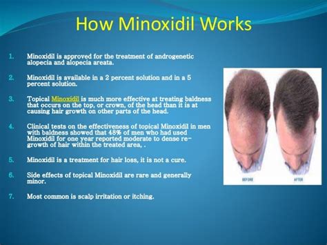 Minoxidil is best medicine to successful cure for hair loss