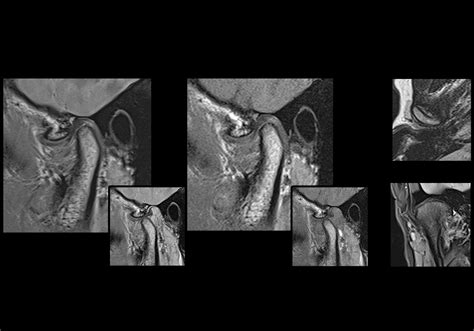 Anatomy of the temporomandibular joint on MRI - e-Anatomy