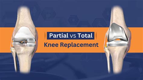 Partial and Total Knee Replacement: Which Is Better? - Wellness Hospitals