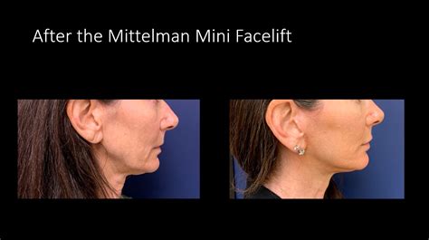 Mini Facelift in Los Altos CA: Age-Defying Transformation