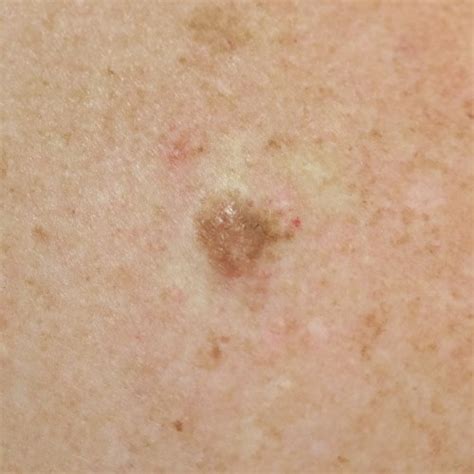 Seborrhoeic keratosis, papilloma | London Mole Removal