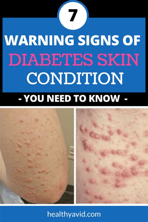 7 Diabetes Skin Problems and Warning Signs You Should Know