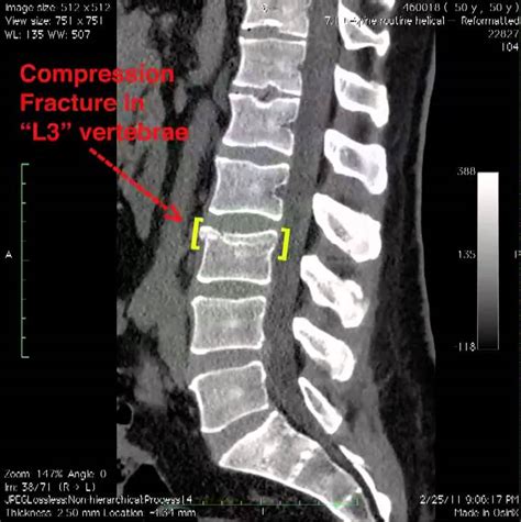 L3 Spinal Compression Fracture.mov - YouTube