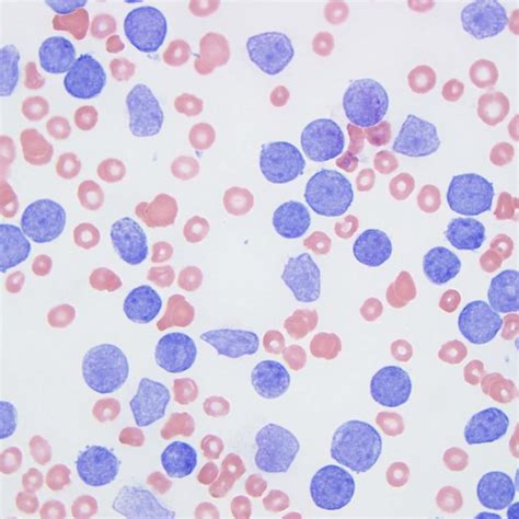 The peripheral blood smear showed marked leukocytosis with ...