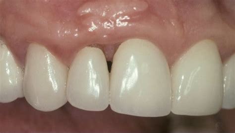 Papilla Reconstruction | Dr. Peter Nordland | Periodontist