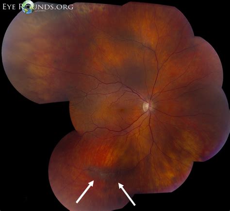 Atlas Entry - Peri-Vascular Lattice Degeneration