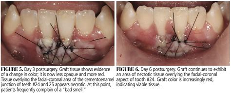 Healing Progression of the Free Gingival Graft - Decisions in Dentistry