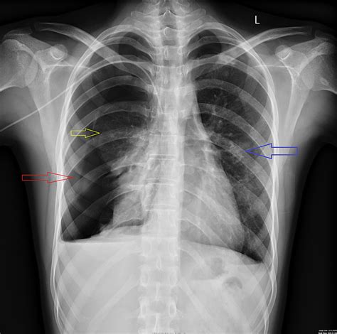 Cureus | Simultaneous Bilateral Spontaneous Pneumothorax: A Rare ...