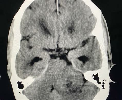 Vestibular Schwannoma - Case Discussion