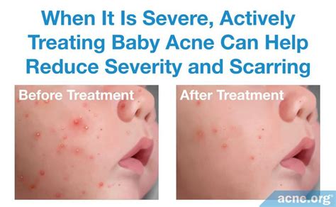 Baby Acne: What Is It, and What Causes It? - Acne.org