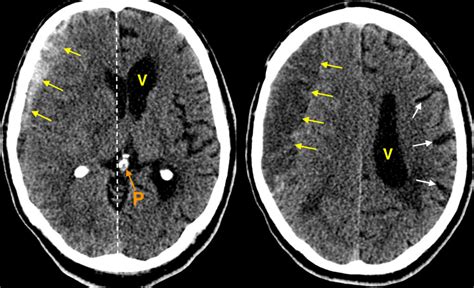 Acute on chronic subdural haematoma - Radiology at St. Vincent's ...