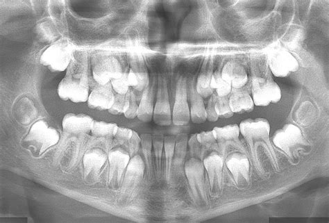 mixed-dentition-radiograph – Ace Achievers