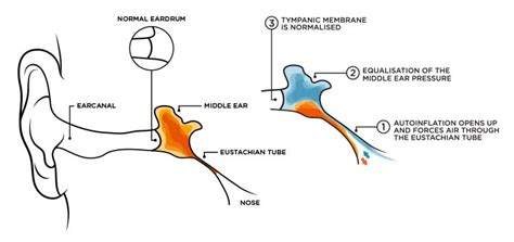 Glue Ear in Adults