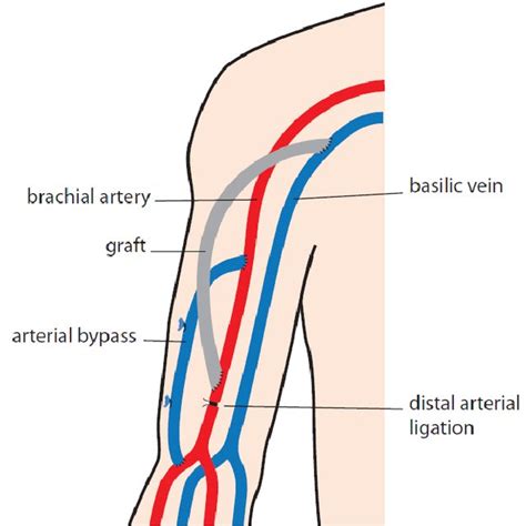 17 Cannulation techniques. A) Rope-ladder technique, B) Area technique ...