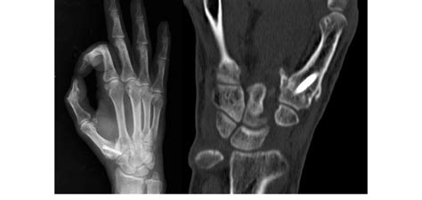 Consolidation of the arthrodesis | Download Scientific Diagram