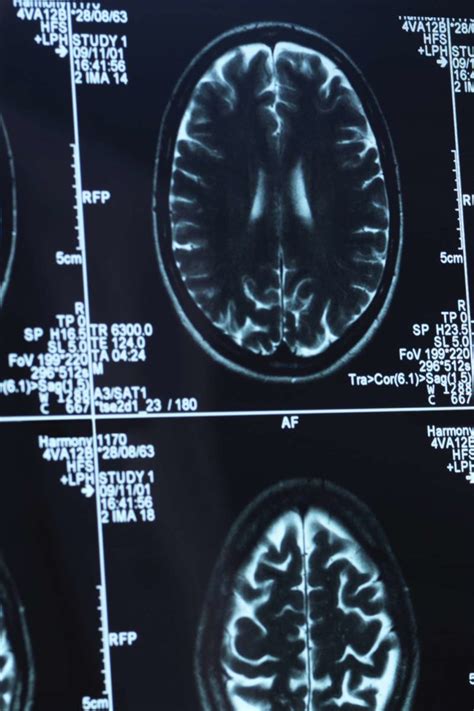 Encephalopathy: Types, causes, symptoms, and treatment