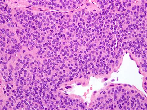 Malignant Tumor Histology