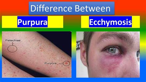 Ecchymosis Vs Petechiae