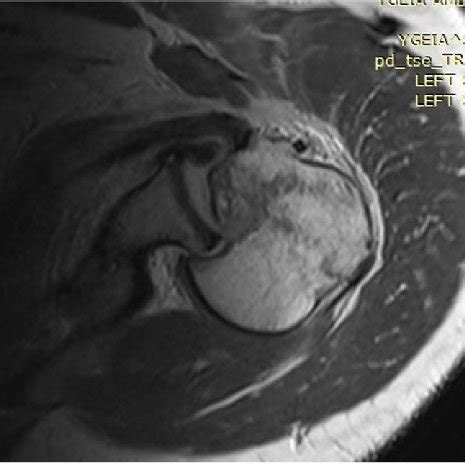 1st patient: MRI scan showing PSD, reverse Hill-Sachs lesion, impaction ...