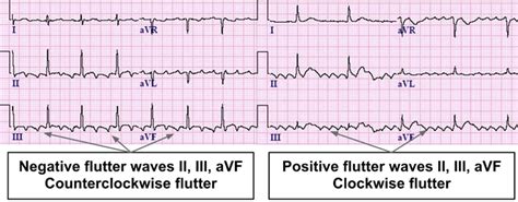 Atrial Fibrillation Vs Atrial Flutter Ecg