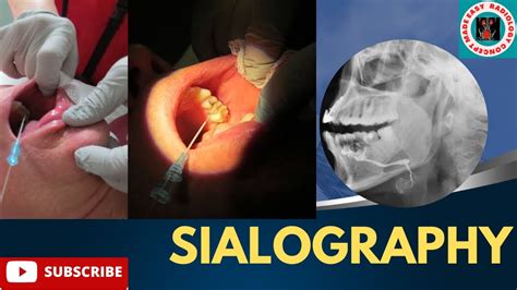 Sialography | Indications & Contraindications | Contrast media ...