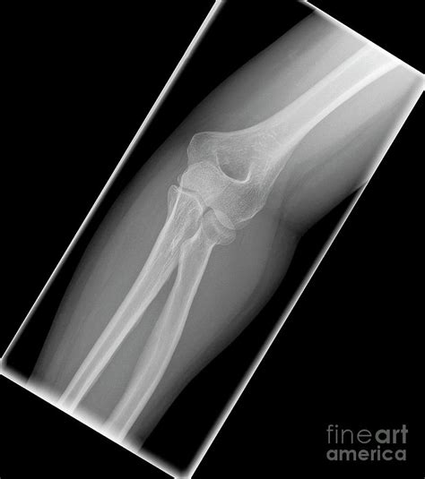 Fracture Of Elbow Bone Photograph by Science Photo Library - Fine Art ...