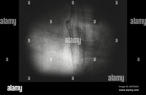 Esophagus x ray Stock Videos & Footage - HD and 4K Video Clips - Alamy