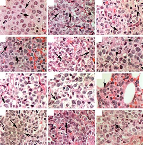 Morphological details of the 10 cases of pleomorphic mantle cell ...