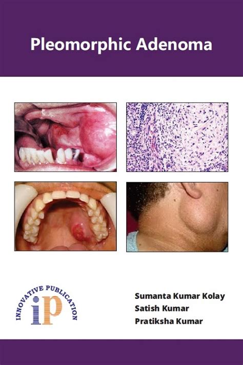 Pleomorphic Adenoma