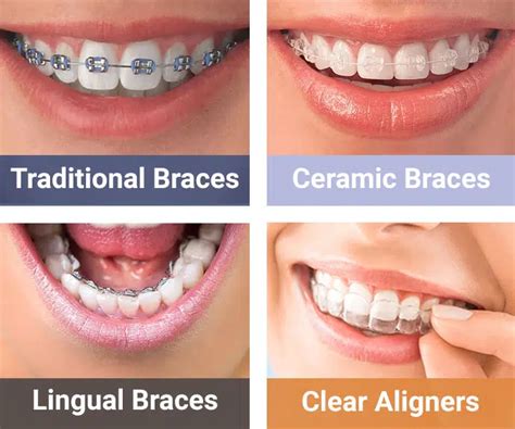 How Braces Work: Different Types of Orthodontics - Vondran Orthodontics