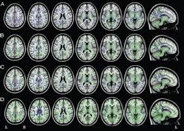 Posterior Cortical Atrophy