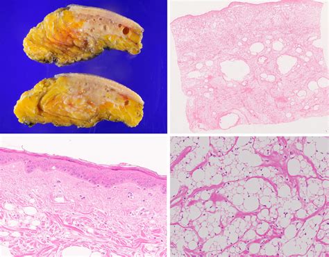 Gross finding and histopathologic findings of specimen after ...