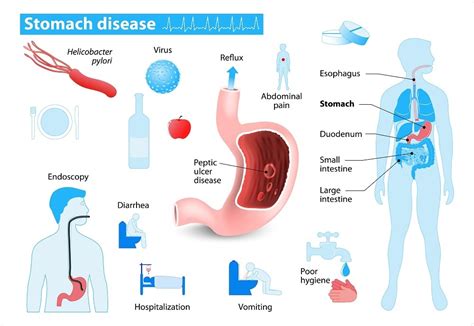 Melena: What Is It, Causes, Symptoms, Bleeding, Treatment,, 45% OFF