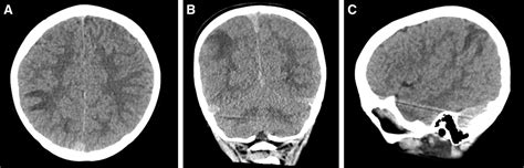 Successful Treatment of a Balamuthia mandrillaris Cerebral A... : The ...