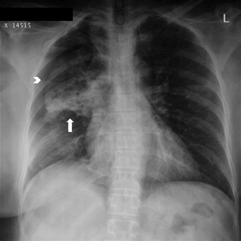 Mucus In Lungs X Ray