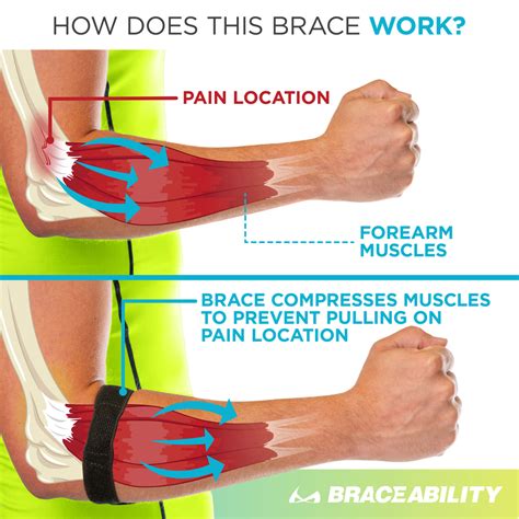 Epicondylitis Brace | Elbow Strap for Medial & Lateral Epicondyle Pain