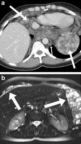 Imaging of lymphangiomatosis. a Axial CT image in a 38-year-old woman ...