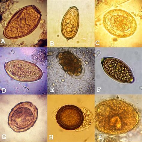 A. Paragonimus westermani B. Clonorchis sinensis C. Hymenolepis nana D ...