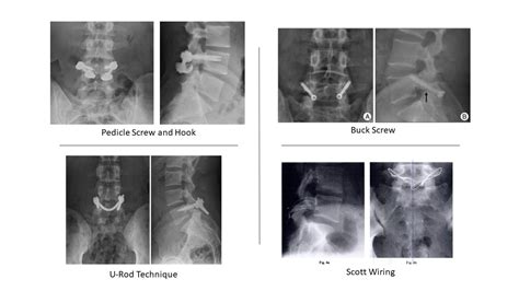 Do You Need Spondylolysis Surgery?