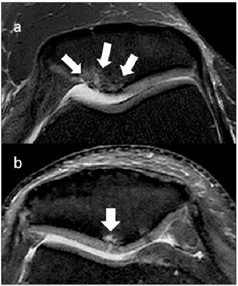 Figure 8 from A new MRI grading system for chondromalacia patellae ...