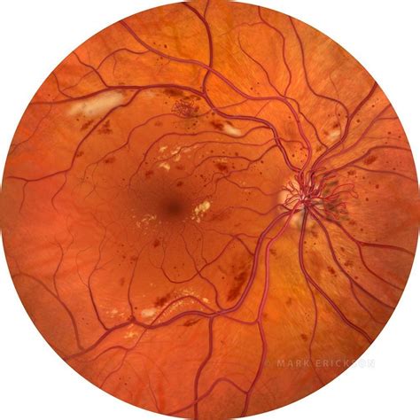 Proliferative diabetic retinopathy fundus illustration featuring NVD ...