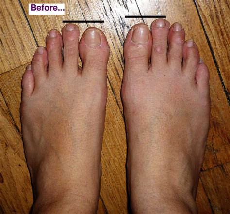 How To Fix Hammer Toes Without Surgery - lottelette’s blog