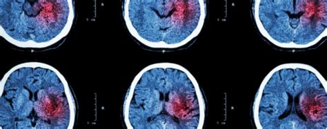 Can Stem Cells Help Brain Injury? | Stemedix