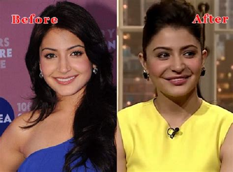 Anushka Sharma Lip Job Controversy: Actress Vents Out Refuting Surgery