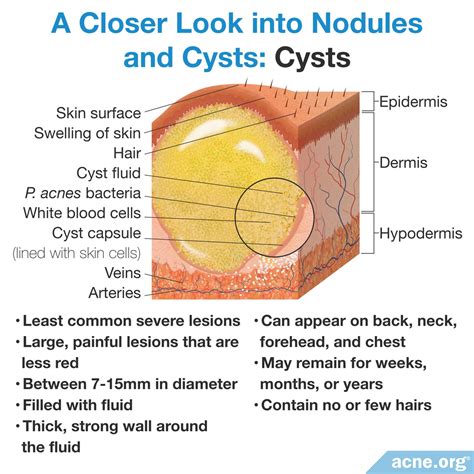 Cystic Acne on the Body - Acne.org