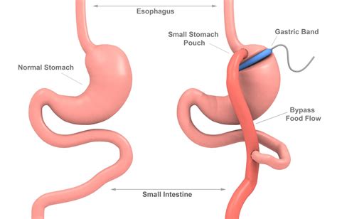 Gastric Banding (Lap-Band Surgery): How It's Done, Risks, What to Expect