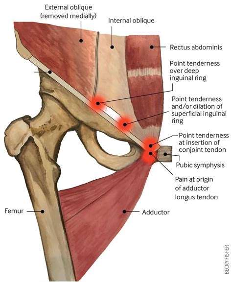 Groin Muscle Anatomy - Groin Muscles Diagram Anatomy Of Groin Muscles ...